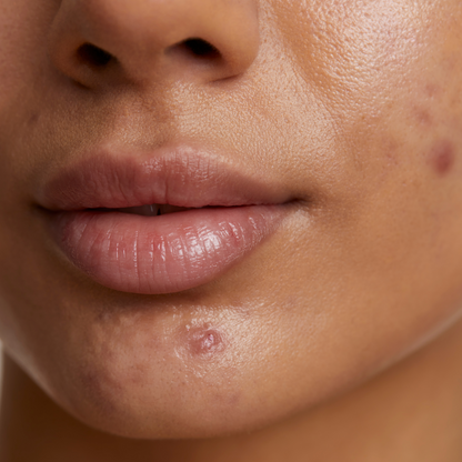 Acne Essentials Kit